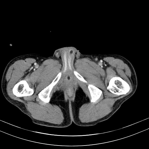 Acute bowel ischemia (Radiopaedia 87695-104114 Axial C+ portal venous phase 91).jpg