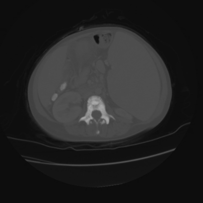 File:Acute calculous cholecystitis in patient with osteopetrosis (Radiopaedia 77871-90159 Axial bone window 25).jpg