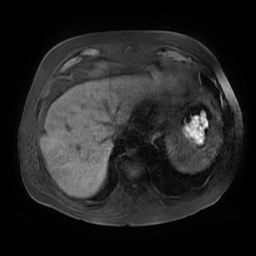 Acute cholecystitis complicated by pylephlebitis (Radiopaedia 65782-74915 Axial T1 fat sat 11).jpg