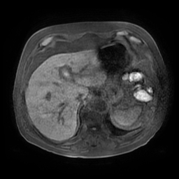Acute cholecystitis complicated by pylephlebitis (Radiopaedia 65782-74915 Axial T1 fat sat 22).jpg