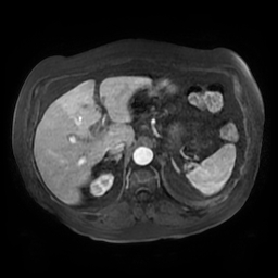 File:Acute cholecystitis complicated by pylephlebitis (Radiopaedia 65782-74915 Axial arterioportal phase T1 C+ fat sat 43).jpg