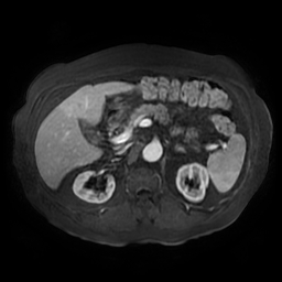 Acute cholecystitis complicated by pylephlebitis (Radiopaedia 65782-74915 Axial arterioportal phase T1 C+ fat sat 63).jpg