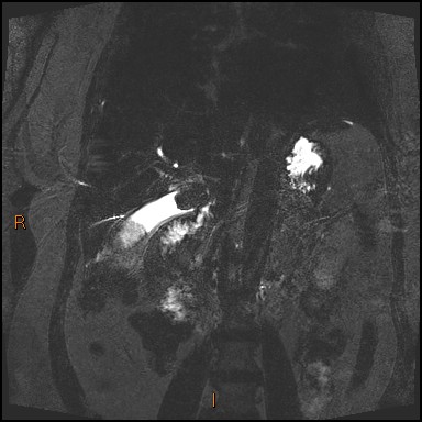 File:Acute cholecystitis with gallbladder neck calculus (Radiopaedia 42795-45971 Coronal Turbo spin echo 15).jpg