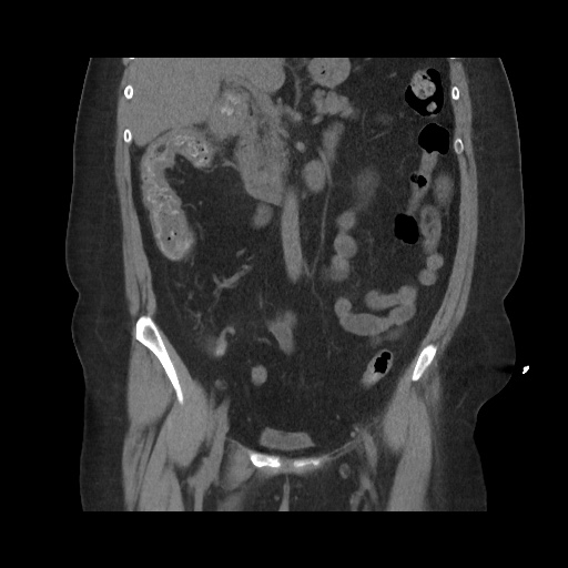 File:Acute cholecystitis with tensile fundus sign (Radiopaedia 71394-81723 Coronal non-contrast 63).jpg