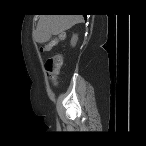 File:Acute cholecystitis with tensile fundus sign (Radiopaedia 71394-81723 Sagittal non-contrast 54).jpg