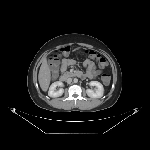 File:Acute complicated calculous cholecystitis (Radiopaedia 55202-61587 Axial C+ delayed 44).jpg