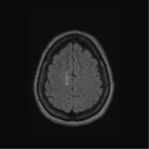 Acute disseminated encephalomyelitis (ADEM) (Radiopaedia 38073-40065 Axial FLAIR 55).png