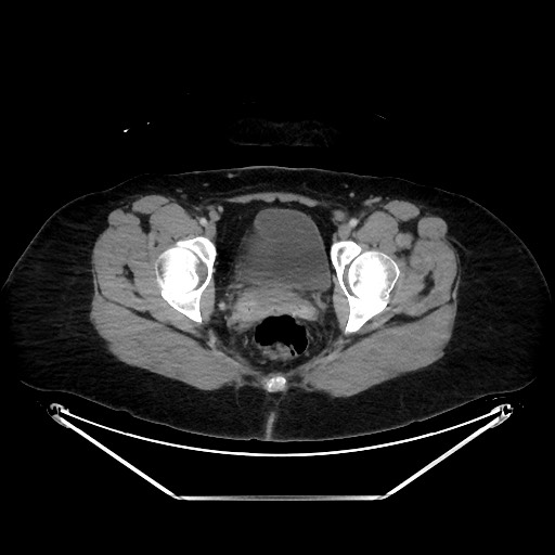 Acute diverticulitis - transverse colon (Radiopaedia 87063-103327 Axial C+ portal venous phase 156).jpg