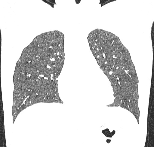 Acute hypersensitivity pneumonitis (Radiopaedia 85293-100870 Coronal lung window 43).jpg