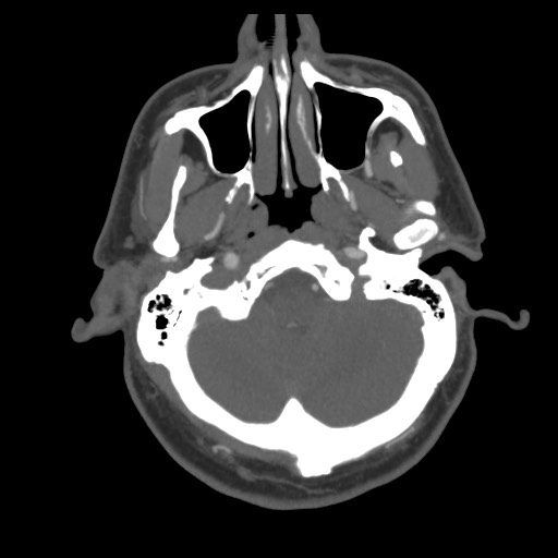 File:Acute internal carotid artery dissection (Radiopaedia 53541-59630 D 13).jpg