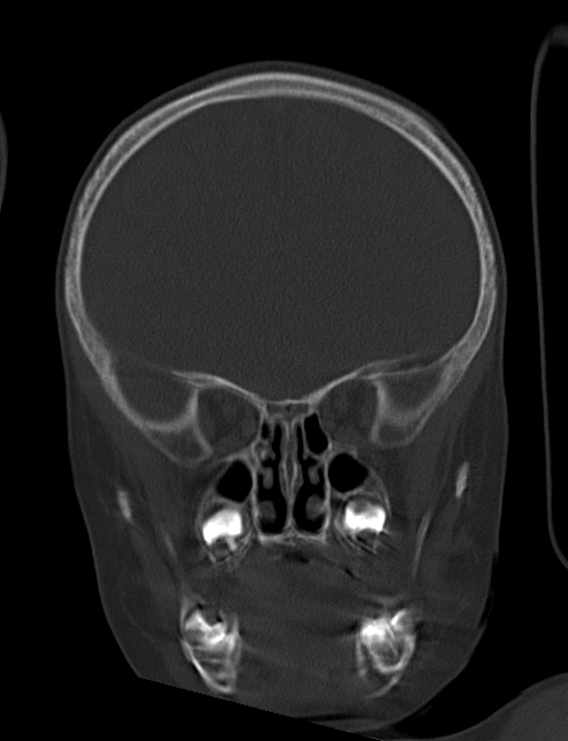 Acute mastoiditis (Radiopaedia 82678-96881 Coronal bone window 22).jpg