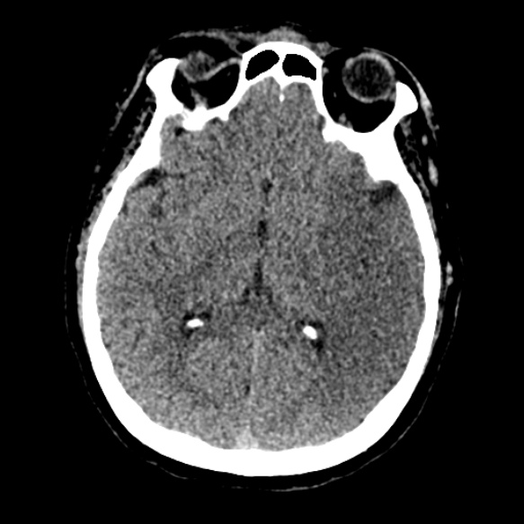 Acute middle cerebral artery territory infarct (Radiopaedia 52380-58283 Axial non-contrast 50).jpg