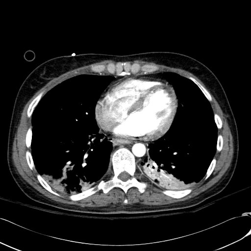 Acute myocardial infarction in CT (Radiopaedia 39947-42415 Axial C+ arterial phase 93).jpg