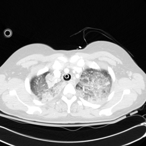 Acute myocardial infarction in CT (Radiopaedia 39947-42415 Axial lung window 21).jpg