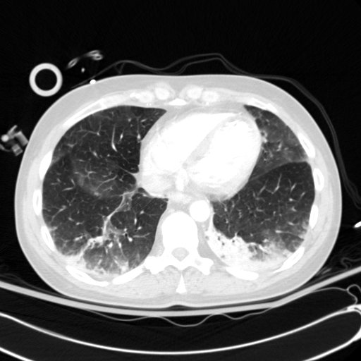 Acute myocardial infarction in CT (Radiopaedia 39947-42415 Axial lung window 98).jpg