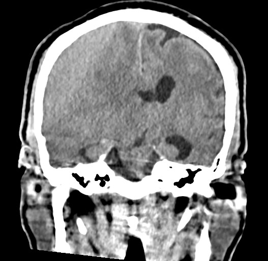 Acute on chronic subdural hematoma (Radiopaedia 78346-90966 Coronal non-contrast 36).jpg