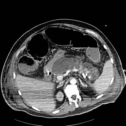 File:Acute pancreatic necrosis (Radiopaedia 13560-18502 Axial C+ portal venous phase 20).jpg