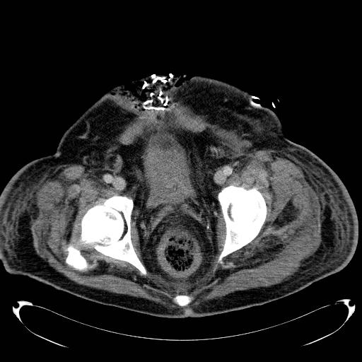 Acute pancreatic necrosis (Radiopaedia 13560-18503 Axial C+ portal venous phase 77).jpg