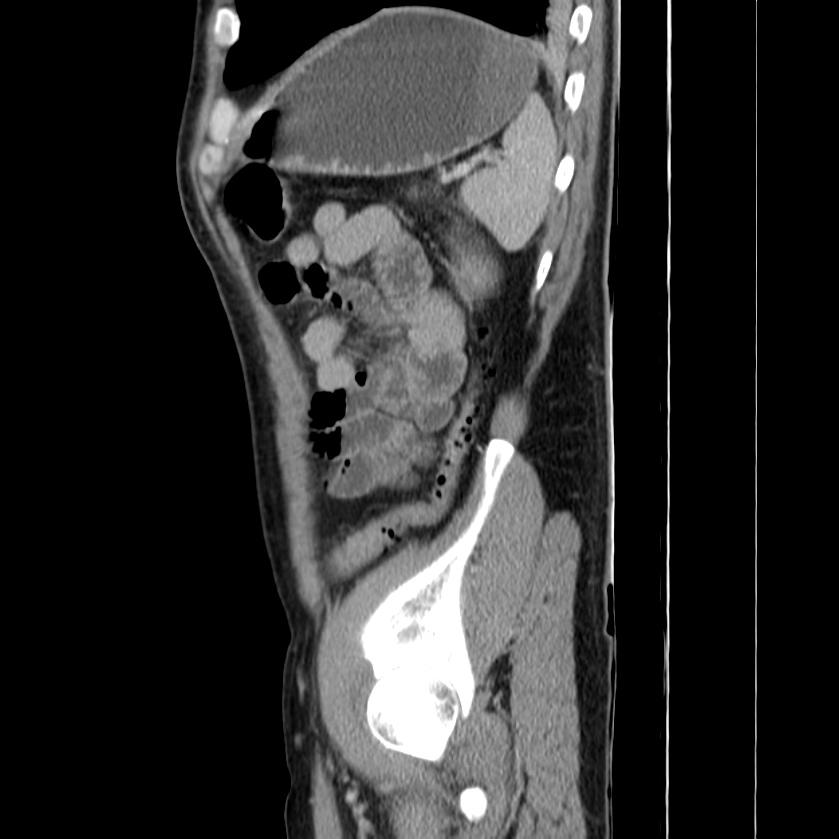 Acute pancreatitis (Radiopaedia 22572-22596 Sagittal C+ portal venous phase 44).jpg