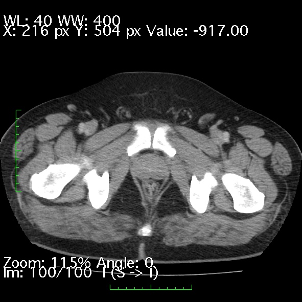 Acute pancreatitis (Radiopaedia 34043-35276 Axial C+ portal venous phase 100).jpg