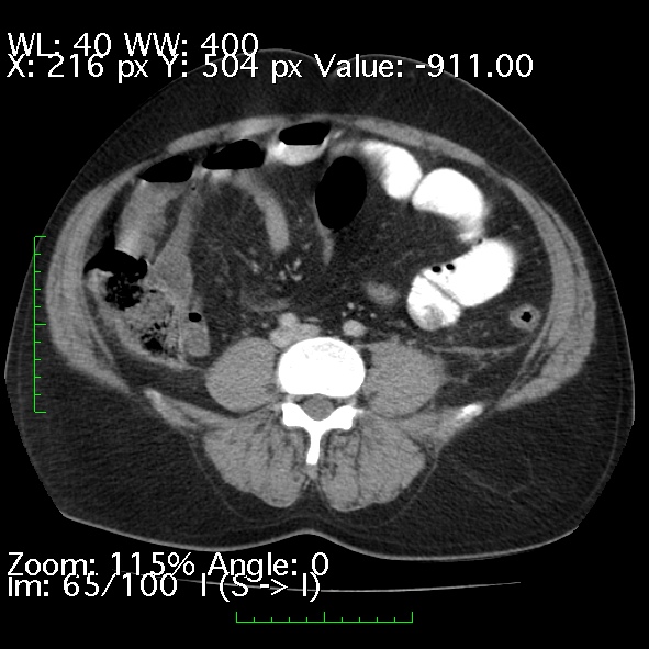 Acute pancreatitis (Radiopaedia 34043-35276 Axial C+ portal venous phase 65).jpg