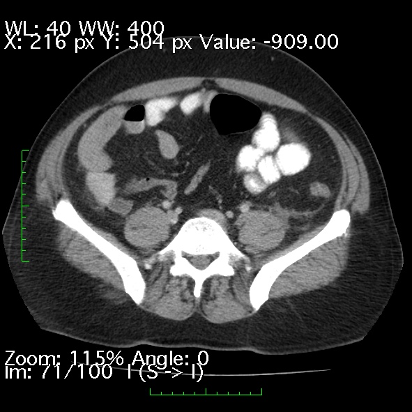 Acute pancreatitis (Radiopaedia 34043-35276 Axial C+ portal venous phase 71).jpg