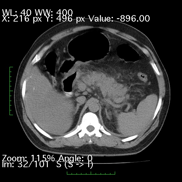 Acute pancreatitis (Radiopaedia 34043-35276 Axial non-contrast 32).jpg