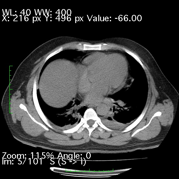 Acute pancreatitis (Radiopaedia 34043-35276 Axial non-contrast 5).jpg