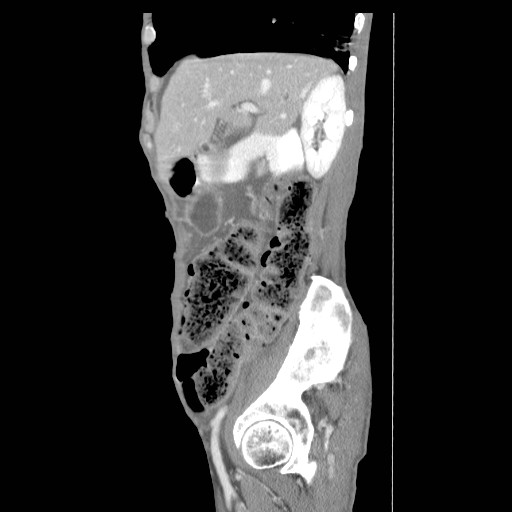 File:Acute pancreatitis (Radiopaedia 50213-55558 Sagittal C+ portal venous phase 10).jpg
