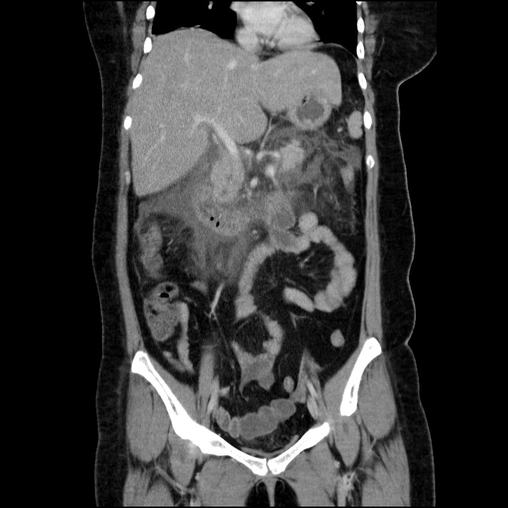 Acute pancreatitis (Radiopaedia 69236-79012 Coronal C+ portal venous phase 42).jpg