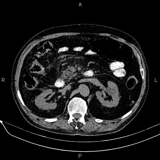 Acute pancreatitis (Radiopaedia 85146-100701 Axial non-contrast 51).jpg
