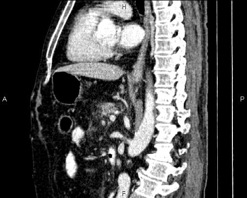 Acute pancreatitis (Radiopaedia 85146-100701 Sagittal C+ portal venous phase 51).jpg