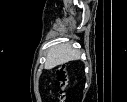 Acute pancreatitis (Radiopaedia 85146-100701 Sagittal C+ portal venous phase 6).jpg