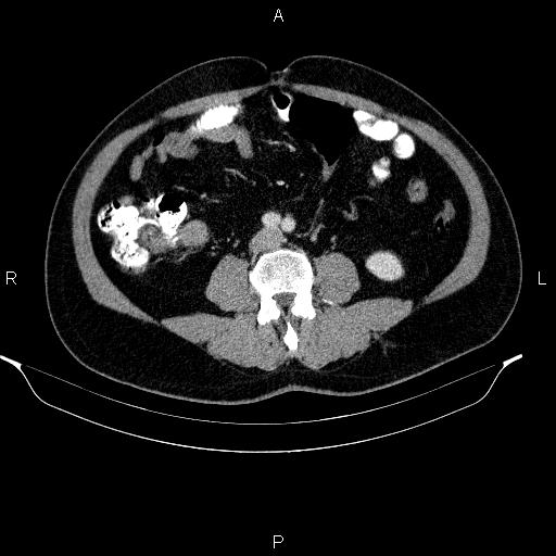 Acute pancreatitis (Radiopaedia 85390-101010 Axial C+ portal venous phase 64).jpg