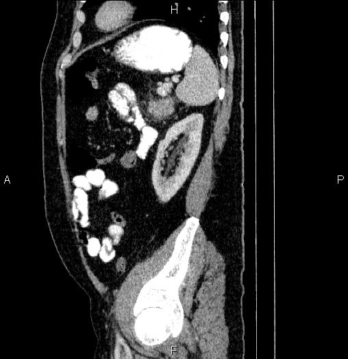 File:Acute pancreatitis (Radiopaedia 85390-101010 Sagittal C+ portal venous phase 79).jpg