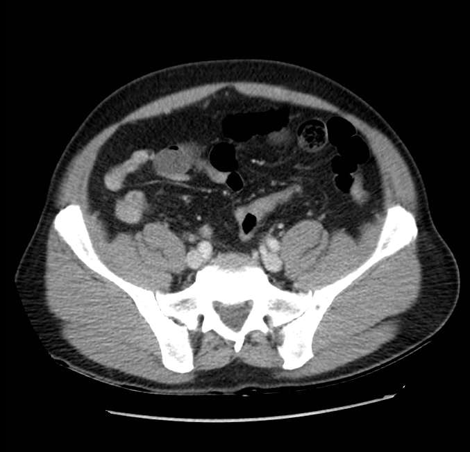 Acute pancreatitis - Balthazar E (Radiopaedia 23080-23110 Axial C+ portal venous phase 53).jpg