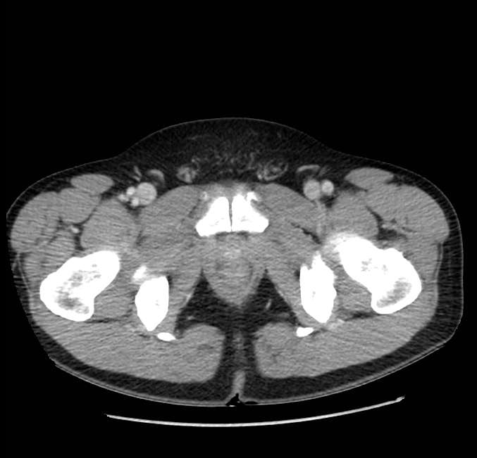 Acute pancreatitis - Balthazar E (Radiopaedia 23080-23110 Axial C+ portal venous phase 75).jpg