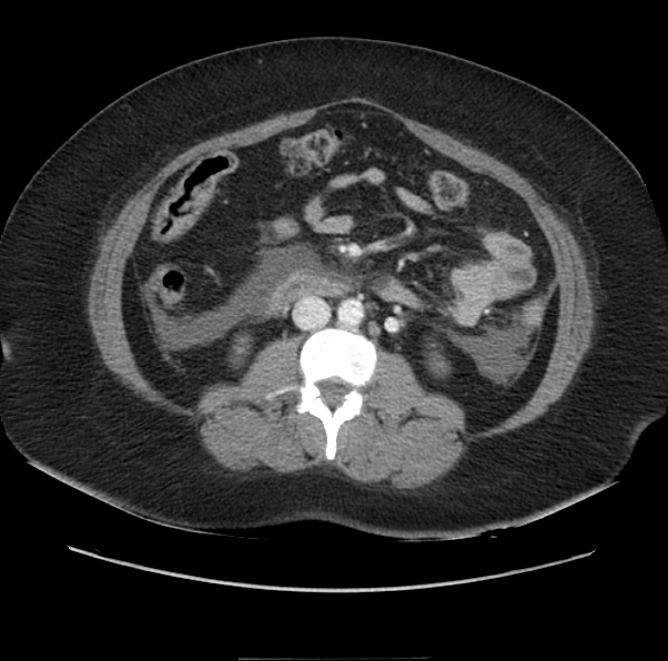 Acute pancreatitis - Balthazar E (Radiopaedia 29016-29377 Axial C+ portal venous phase 36).png