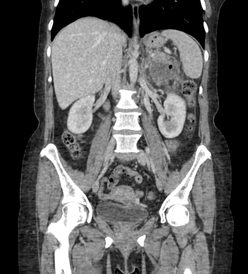 Acute pancreatitis - Balthazar E - post ERCP (Radiopaedia 27562-27772 Coronal C+ portal venous phase 46).png