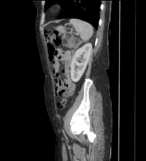 Acute pancreatitis - Balthazar E - post ERCP (Radiopaedia 27562-27772 Sagittal C+ portal venous phase 105).png