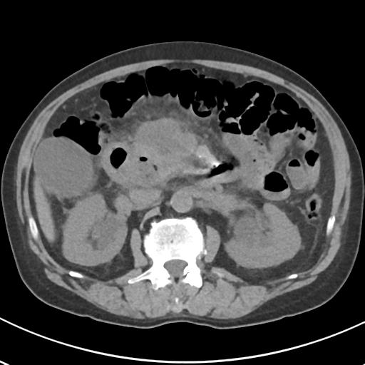 File:Acute pancreatitis and walled-off necrosis (Radiopaedia 29888-30404 Axial non-contrast 32).jpg