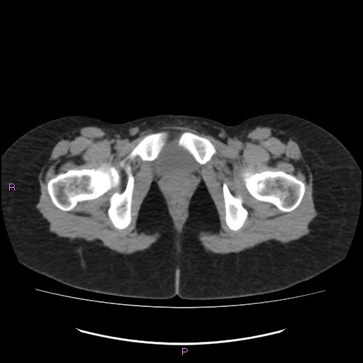 Acute pancreatitis secondary to stone at minor papilla and pancreatic divisum (Radiopaedia 76570-88333 Axial non-contrast 80).jpg
