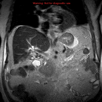 File:Acute pancreatitis with incidental pancreatic lipoma (Radiopaedia 10190-10732 Coronal T2 15).jpg