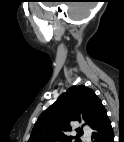 Acute parotitis (Radiopaedia 27425-27619 Sagittal C+ portal venous phase 44).png