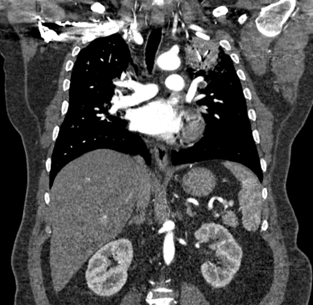 Acute pulmonary embolism with pulmonary infarcts (Radiopaedia 77688-89908 Coronal C+ CTPA 50).jpg