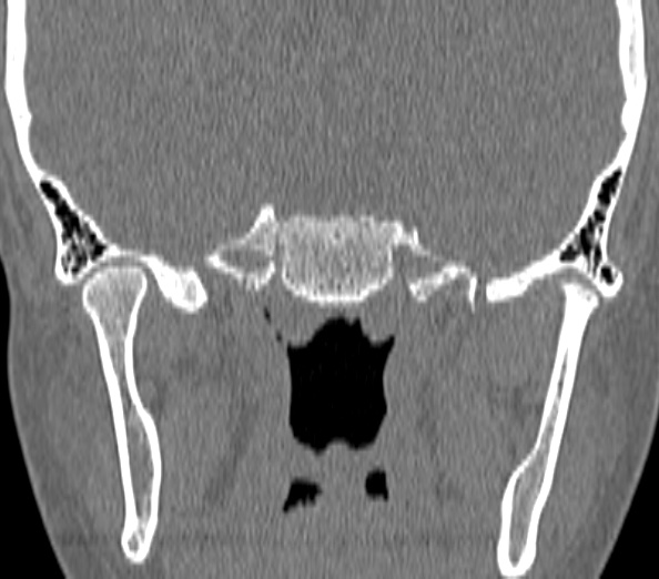 Acute sinusitis (Radiopaedia 40564-43158 Coronal bone window 48).jpg