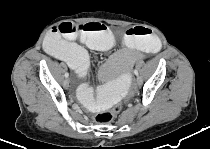 Acute small bowel (ileal) volvulus (Radiopaedia 71740-82139 Axial C+ portal venous phase 162).jpg