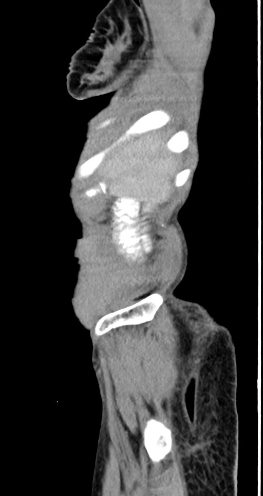 Acute small bowel (ileal) volvulus (Radiopaedia 71740-82139 Sagittal C+ portal venous phase 147).jpg