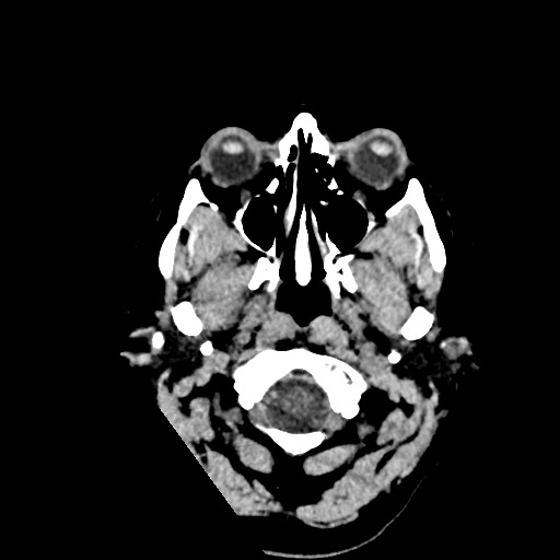 Acute subarachnoid hemorrhage and accessory anterior cerebral artery (Radiopaedia 69231-79008 Axial non-contrast 4).jpg