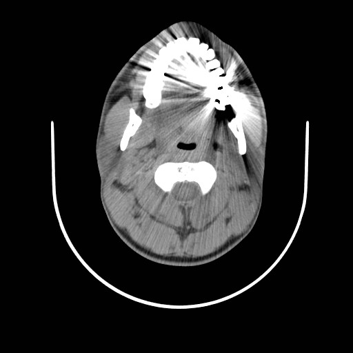 File:Acute submandibular sialadenitis secondary to ductal stone (Radiopaedia 27999-28267 Axial non-contrast 5).jpg